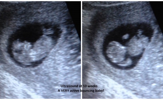 PicMonkey Collage #2 ultrasound 10 weeks